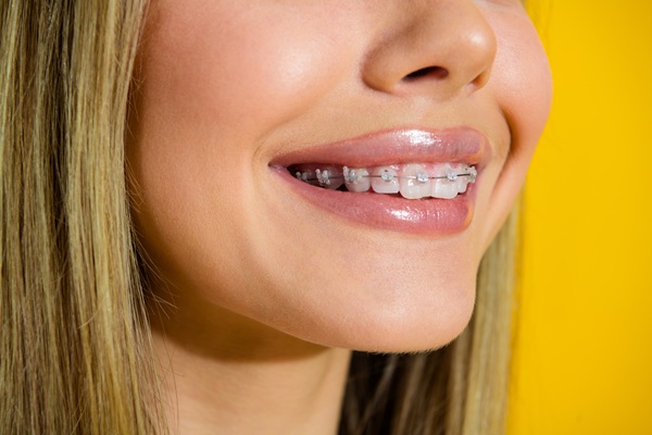How To Take Care Of Your Teeth While You Have Clear Braces