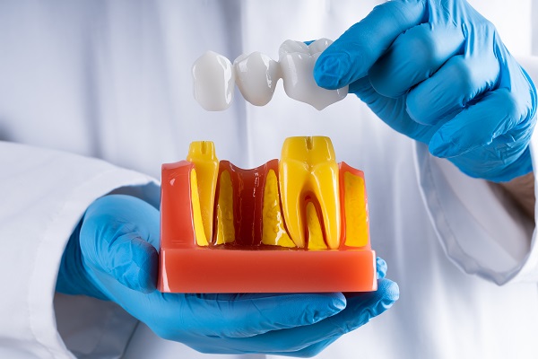 General Dentistry: What Is A Tooth Bridge?