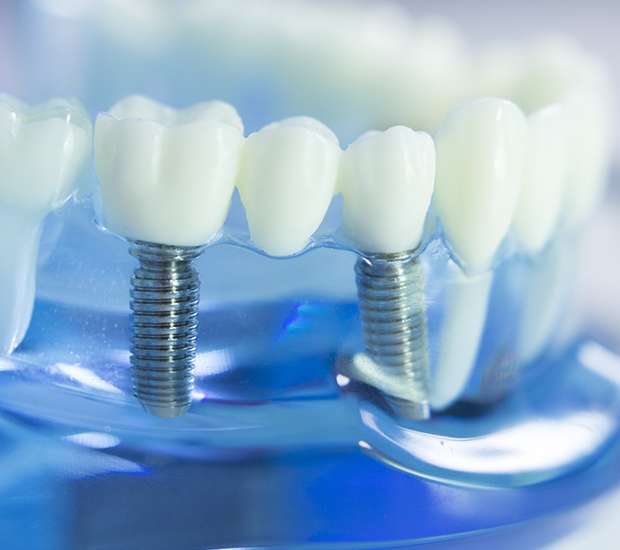 Glendale Dental Implants