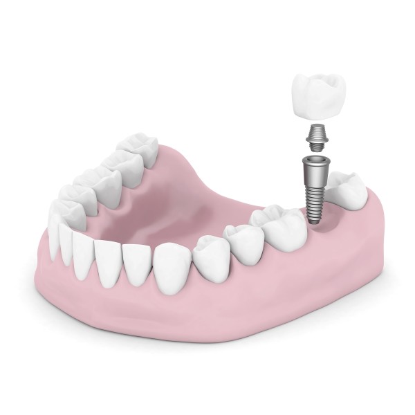 Dental Implants Vs  Dental Bridges