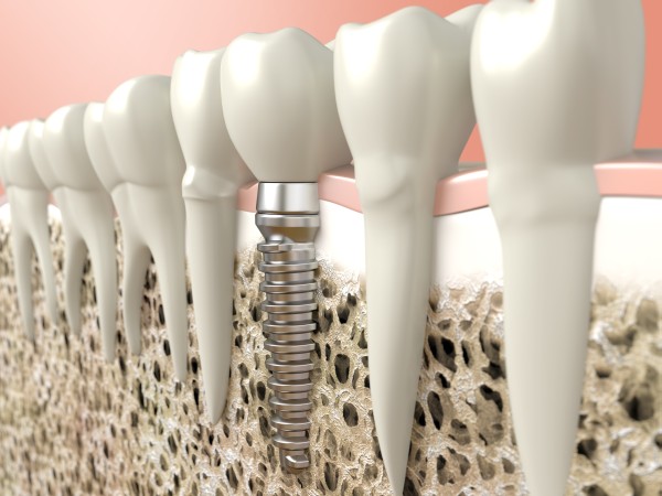 Why You Should Consider Dental Sealants In Glendale