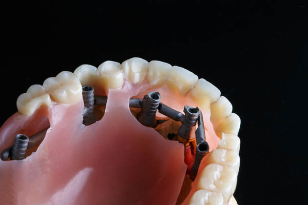 Implant Supported Dentures Glendale, CA