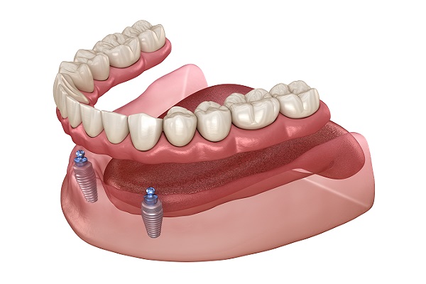 How Many Implants Are Needed For Implant Supported Dentures?