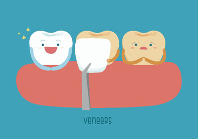 Visit A Veneers Dentist To Straighten The Appearance Of Your Teeth